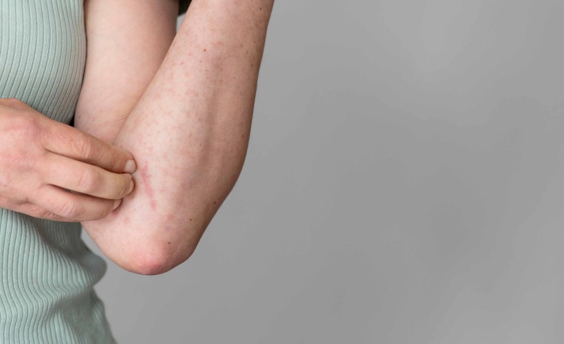 Egzama: Nedir, Nasıl Beslenilmelidir?